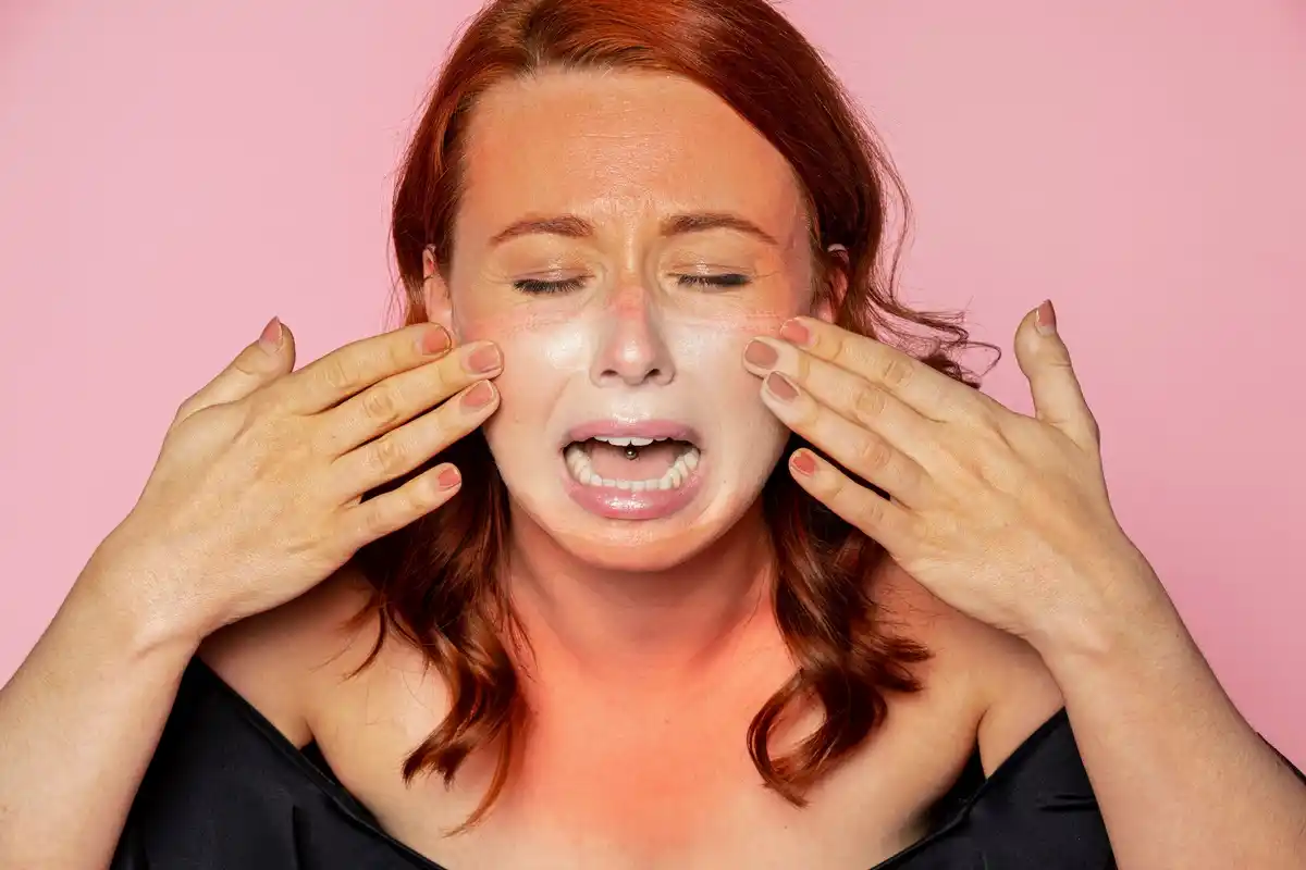 skin damage acid peeling close up Dutch woman