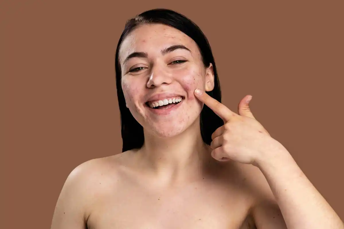 skin irritation after toothpaste acne home remedy